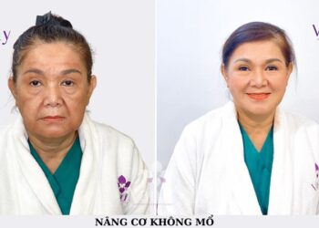 Xóa nhăn cấp tốc bằng phương pháp độc quyền tại VANITY
